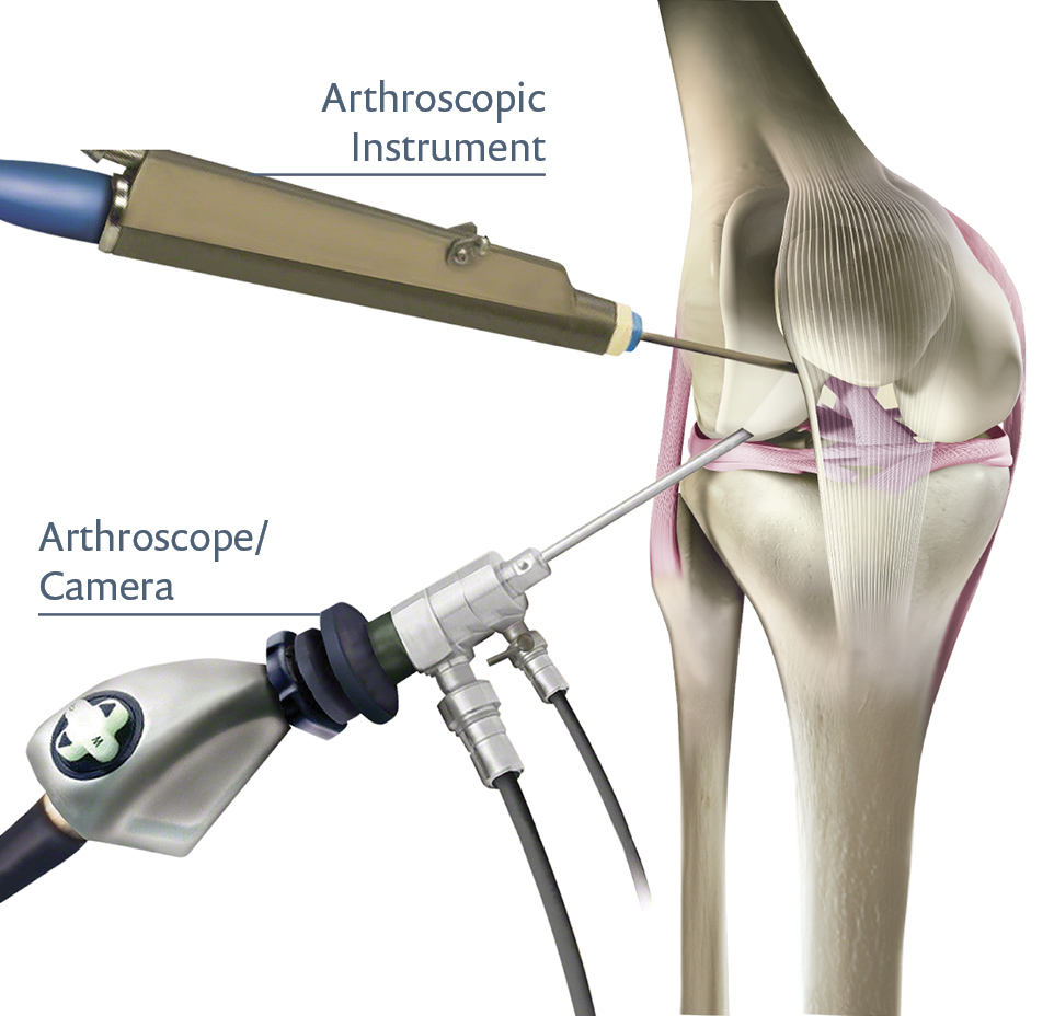 Arthroscopy